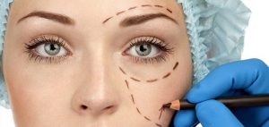 blefaroplastia-cirugia-de-parpados