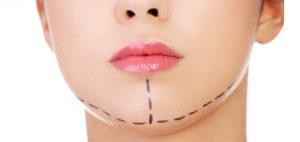 cirugia-mentoplastia