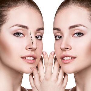 cirugia-rinoplastia