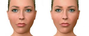 asimetria-facial-madrid