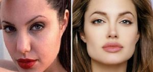 bichectomia-angelina-jolie