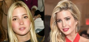 bichectomia-ivanka-trump