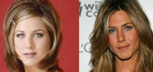 bichectomia-jenifer-aniston