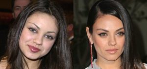 bichectomia-mila-kunis