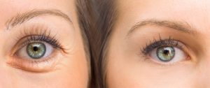 blefaroplastia-laser-tratamientos-con-laser-madrid