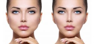 cirugia-bichectomia-adelgazamiento-facial