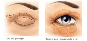cirugia-de-parpados-blefaroplastia-madrid