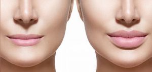 cirugia-elevacion-aumento-de-labios-madrid