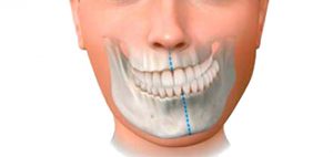 cirugia-ortognatica-asimetria-facial-madrid