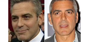 george-clooney-blefaroplastia