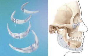 implantes-faciales