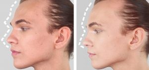 lifting-de-cejas-remodelado-frontoorbitario-madrid