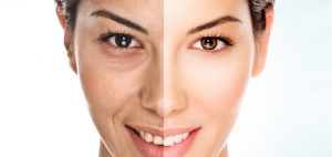 lipofilling-remodelado-facial