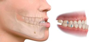 prognatismo-clase-iii-mandibula-grande