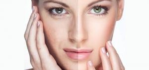 rejuvenecimiento-facial-con-laser-co2-resurfing-co2-madrid
