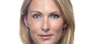 rejuvenecimiento-facial-o-resurfacing-con-laser-de-CO2-microfraccionado-madrid