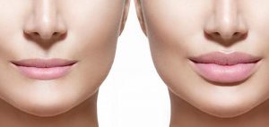 rellenos-faciales-aumento-de-labios-madrid