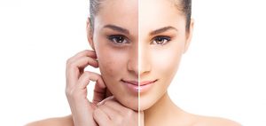 tratamientos-con-laser-co2-resurfing-rejuvenecimiento-facial-madrid
